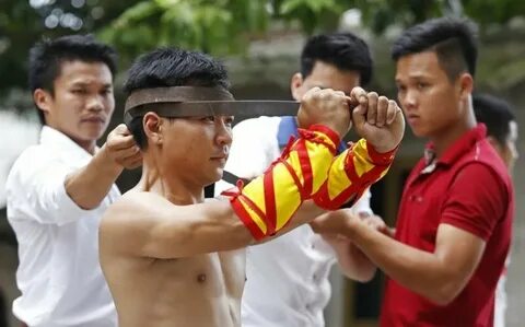 Nốt ruồi khổng lồ phủ kín hộp sọ khiến cậu bé có ngoại hình giống chuột Mickey